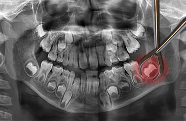 Extraction dents de sagesses